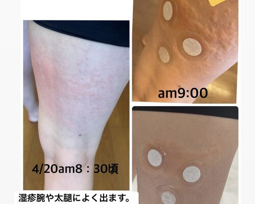パッチ足の湿疹