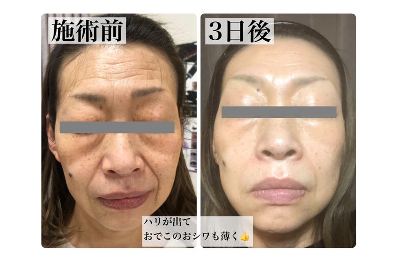 ビフォアフ
